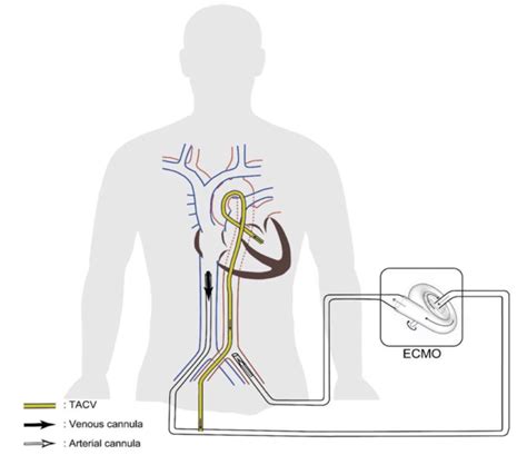 lv venting|left ventricular vent catheter.